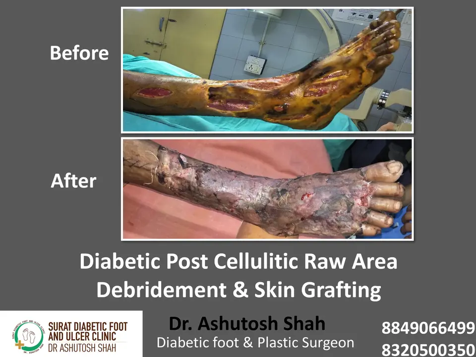 Diabetic Cellulitis and Coverage.pptx-10.webp